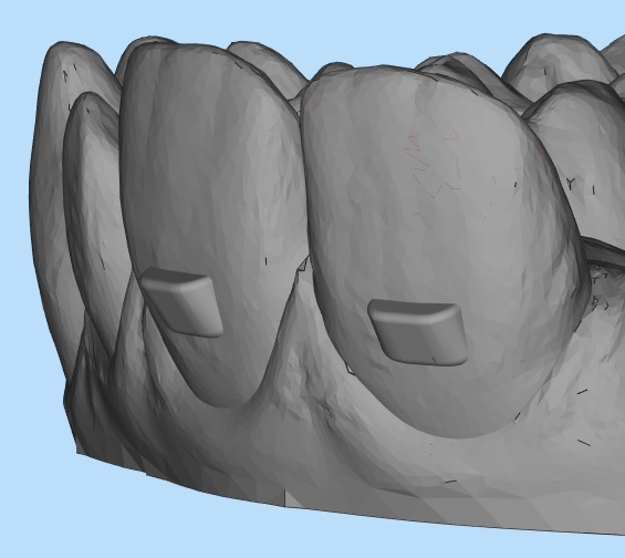 Clear Aligner Attachments Explained Enhancing Orthodontic Treatment