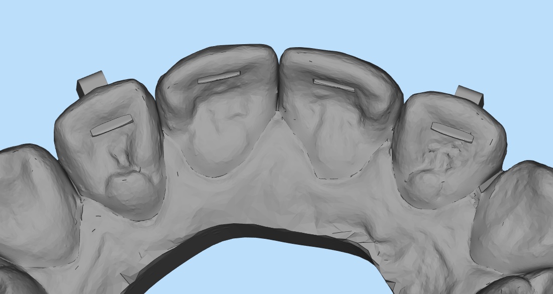 POWER OF INVISALIGN TREATMENT