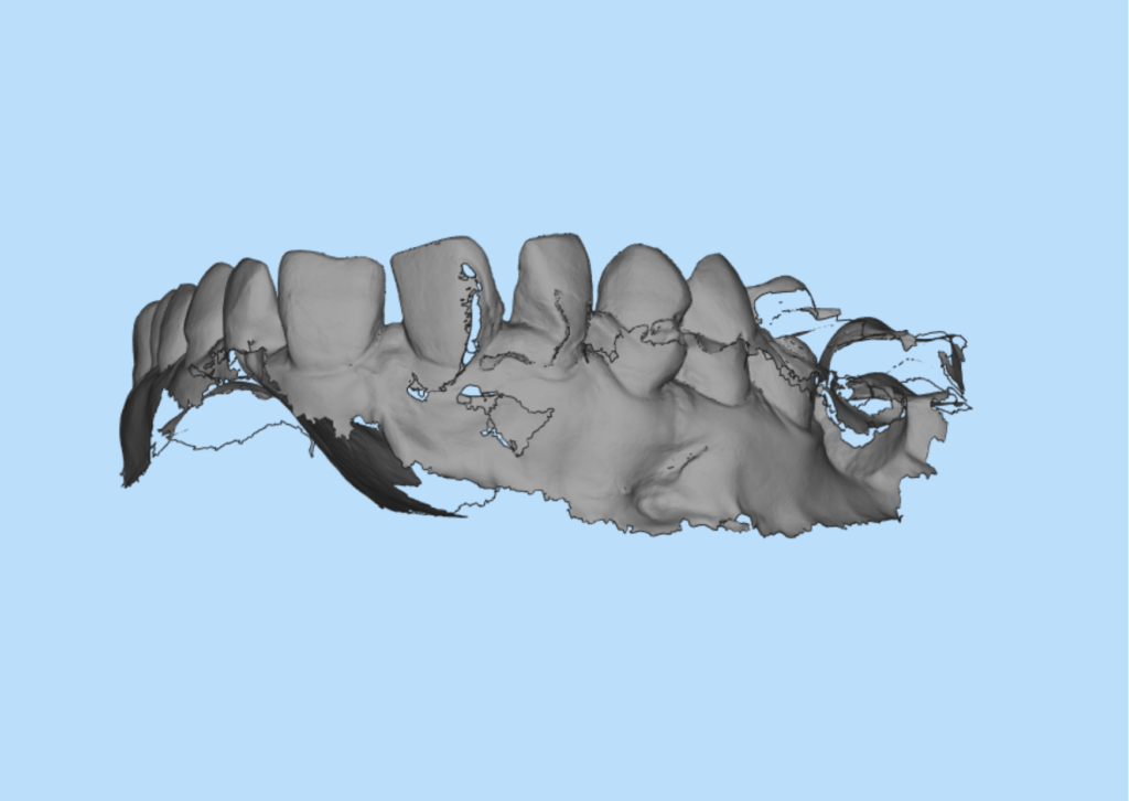 Intraoral Scanner